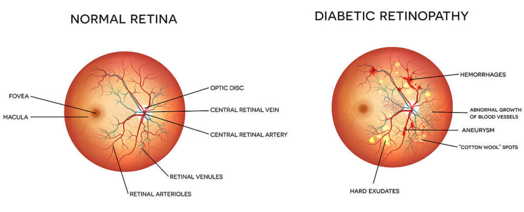 Chart Showing a Normal Retina Compared to One With Diabetic Retinopathy