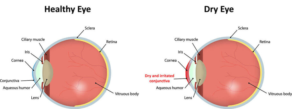 Chart Illustrating a Healthy Eye vs One Experiencing Dry Eye