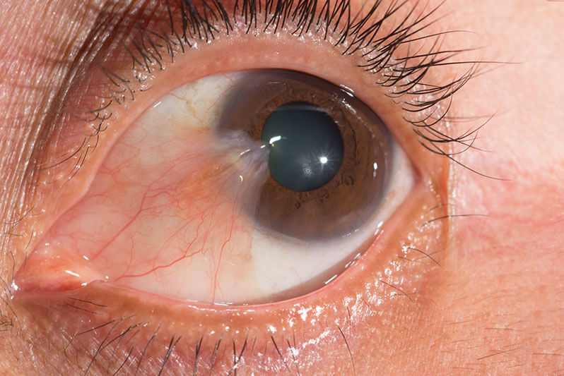 Closeup of an Eye With Pterygium